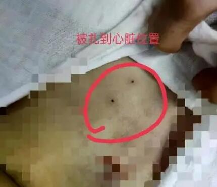 医院回应穿刺失误致女童死亡  究竟是怎么回事？